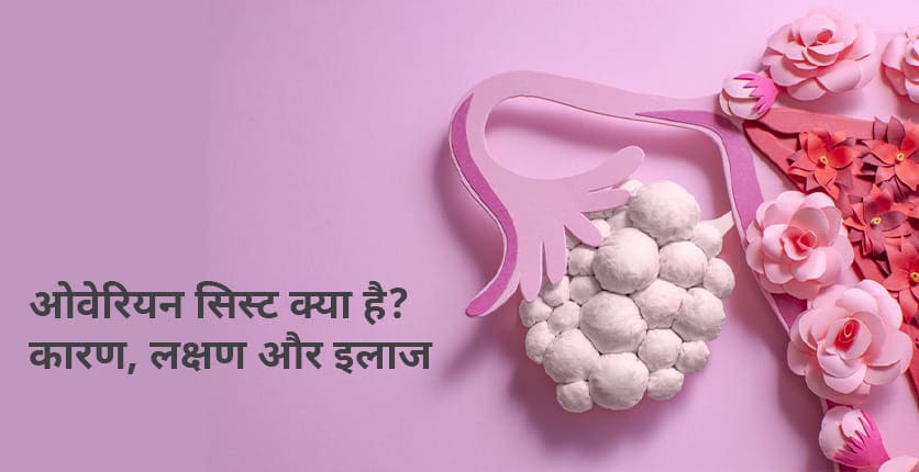 Ovarian Cyst Meaning in Hindi: ओवेरियन सिस्ट क्या होता है? लक्षण और उपचार